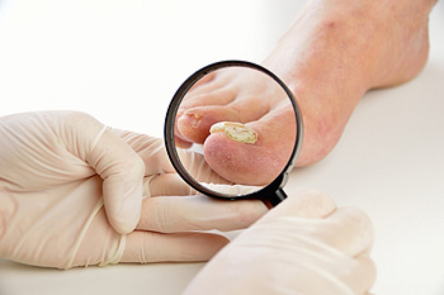 Does a Thick Toenail Mean I Have to Treat a Fungus Infection? 